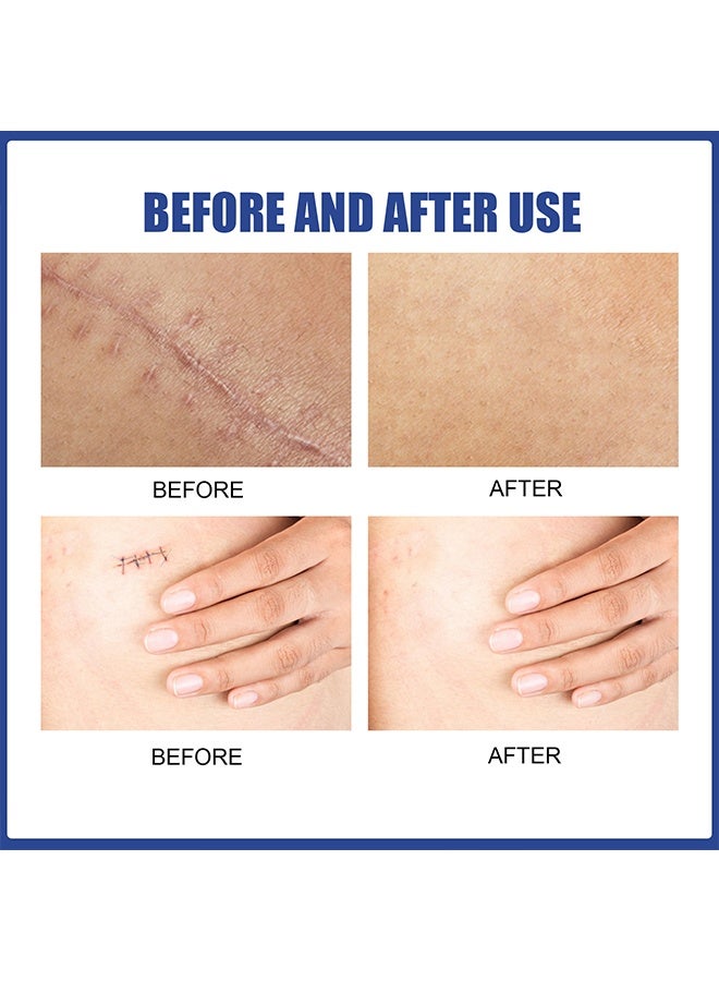 إيلهو أوراق الندوب، شريط السيليكون القابل لإعادة الاستخدام والغسيل لإزالة ندوب الجراحة، علاج ندوب الجراحة، أوراق السيليكون الطبية لإزالة الندوب - 4 أزواج - Image 3