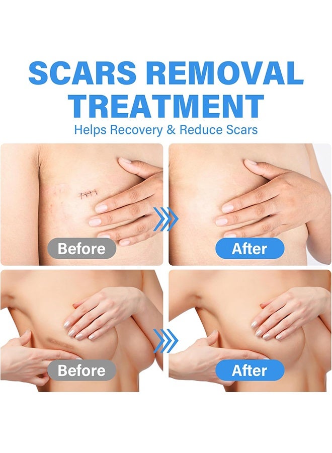 إيلهو أوراق الندوب، شريط السيليكون القابل لإعادة الاستخدام والغسيل لإزالة ندوب الجراحة، علاج ندوب الجراحة، أوراق السيليكون الطبية لإزالة الندوب - 4 أزواج - Image 4