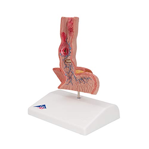 3B Scientific K18 أمراض المريء - 3B Smart Anatomy - Image 2
