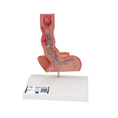 3B Scientific K18 أمراض المريء - 3B Smart Anatomy - Image 1