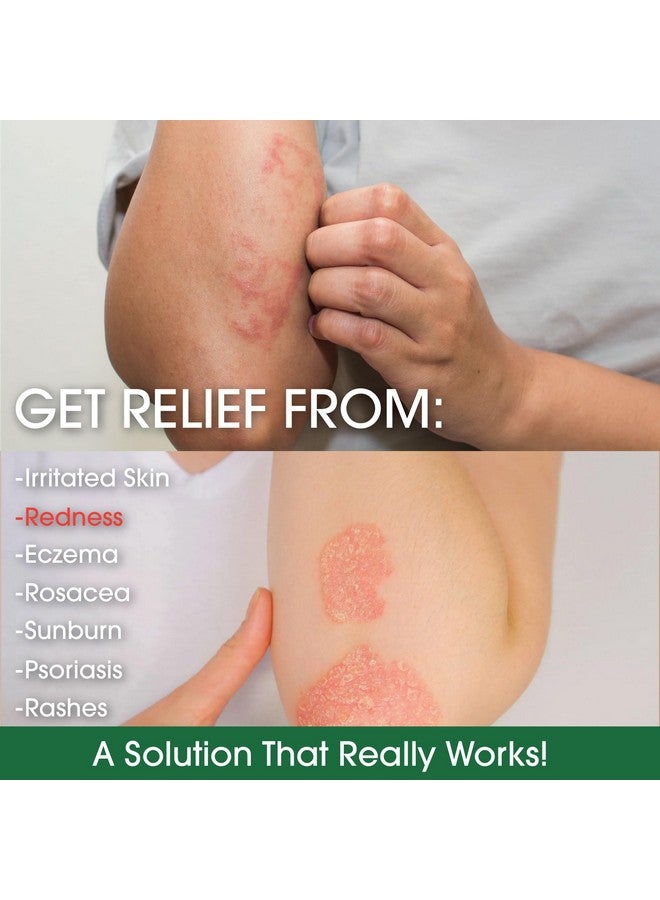 Green Leaf Naturals Manuka Honey Cream - Eczema Honey Cream (4oz) Moisturizer Lotion Treatment for Ezcema & Psoriasis - Ultra Soothing Relief - Face & Body Care, Itchy, Dry Skin Rash Healing Ointment - For Adults & Kids - Image 4