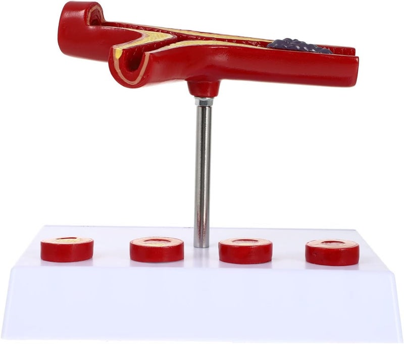 كلاراكو نموذج طبي لتصلب الشرايين البشري للقلب والأوعية الدموية: نموذج تشريحي للأوعية الدموية، لوازم تعليمية طبية لطلاب المدارس - Image 1