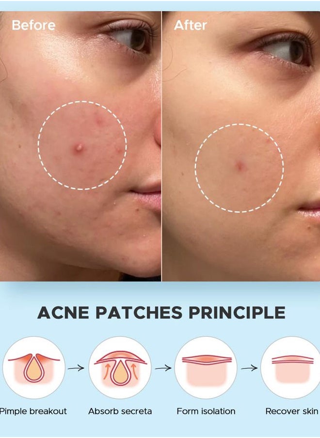 Acne Pimple Patches- Day and Night 4 Sizes 180 Dots Thin & Thick Hydrocolloid Patches with Witch Hazel, Tea Tree & Calendula Oil, Extra Adhesion for Face Zit Patch Dots