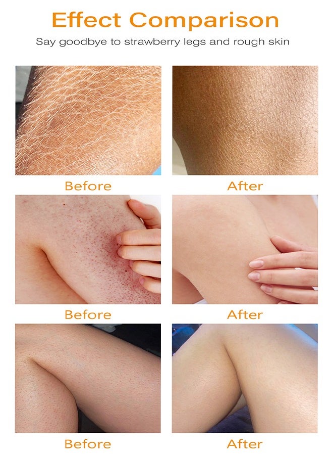 MOOYAM - Women's Strawberry Legs Treatment, Rough Bump Body Cream, Dry Skin Lotion, Strawberry Skin Remover, Pilaris Keratosis Pilaris Treatment Moisturising Cream Body Moisturiser For Brightening Dry Areas 120g - Image 1