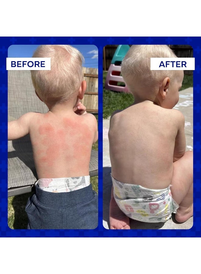 EMUAID Ointment 2oz - Eczema Cream