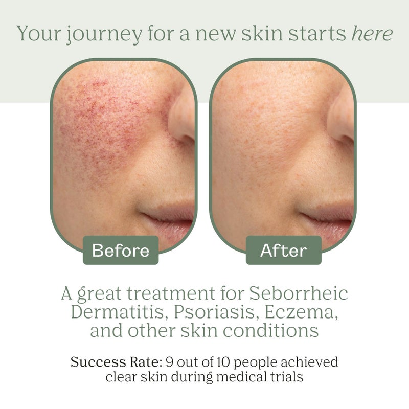 Dermabon Seborrheic Dermatitis Cream, Eczema & Psoriasis Treatment - Calendula Extract, Salicylic Acid, Bee Wax -Soothes, Hydrates & Balances Skin Tone - Moisturizing & Skin Relaxing Relief - Image 2