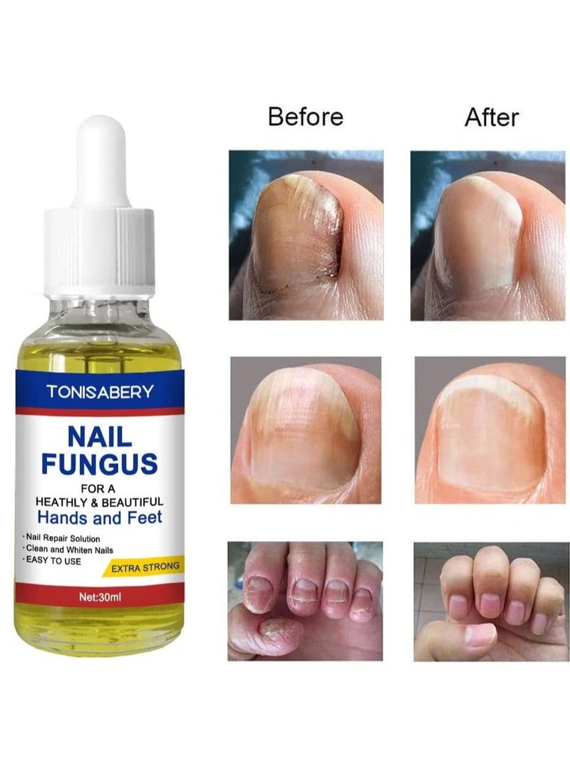 TONISABERY - Nail Fungus Solution For Cracked & Discolored Nails Natural Safe Effective Repairs & Protects Removes Nail Infections Nourishing Fluid for Hand & Feet No Side Effects Irritation Unisex 30ml - Image 1