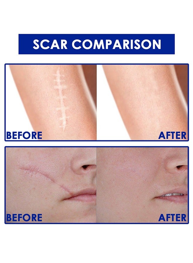 SOUTH MOON Advanced Scar Formula,Scar Repairing Gel,Wound-protecting scar gel burn wound caesarean section scar skin repair gel 15g - Image 4