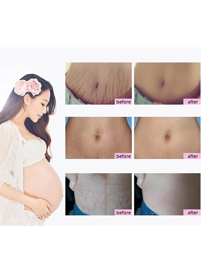 LIFUSHA - Mango Stretch Marks and Scar Cream Stretch Marks and Scar Removal Cream for Pregnancy Stretch Marks Scar Belly Creams for Wrinkles Obesity Stretch Mark Moisturizing Remove Marks 40g - Image 1