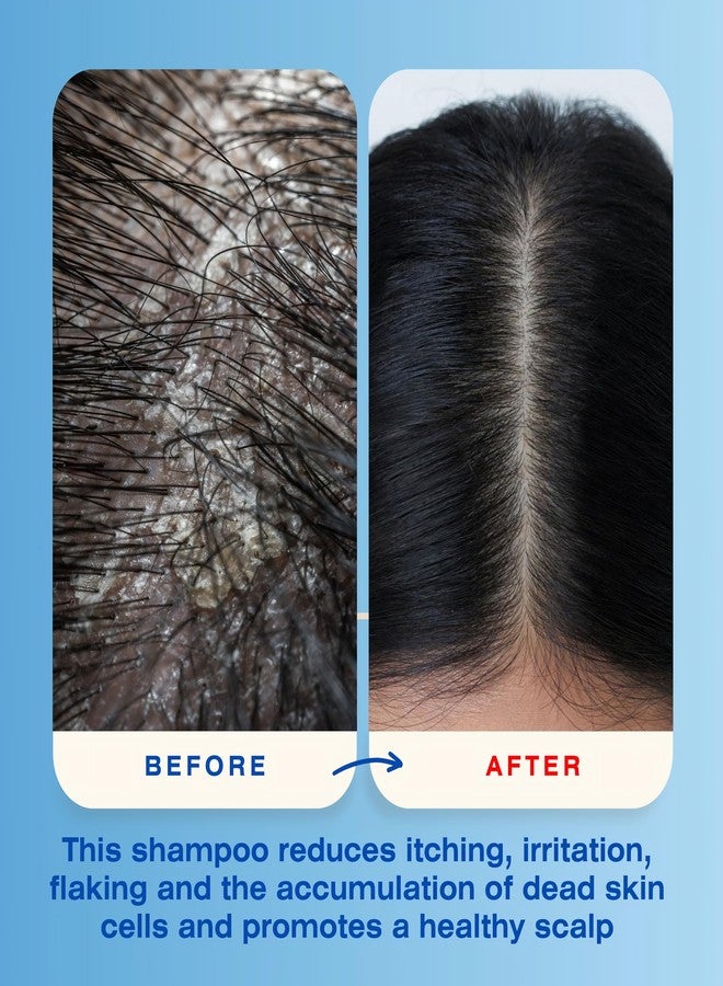 Mediceuticals X-Folate Shampoo Anti Dandruff Shampoo for Women and Men - Persistent Dandruff Control - For Scaly, Flaky Scalp and Scalp Buildup - Reduces Itching - 8.45 oz/ 250ml - Image 5