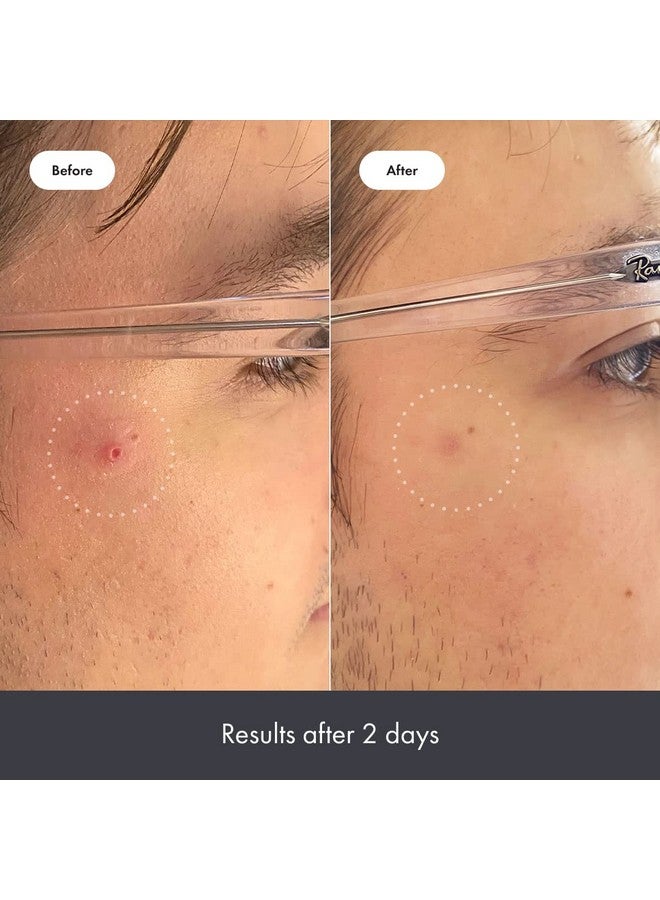 مايتي باتش كريم هيرو كوزماتيكس ريسكيو بالم لعلاج عيوب البشرة بعد ظهورها - تغذية مكثفة وتهدئة للبشرة الجافة والمحمرة بعد ظهور عيوب البشرة - تم اختباره من قبل أطباء الجلدية (50 مل، 1.69 أونصة سائلة) - Image 5