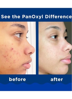 Generic Panoxyl Benzoyl Peroxide 10% Acne Foaming Wash, Maximum Strength Antimicrobial, 5.5 oz.  - Image 3
