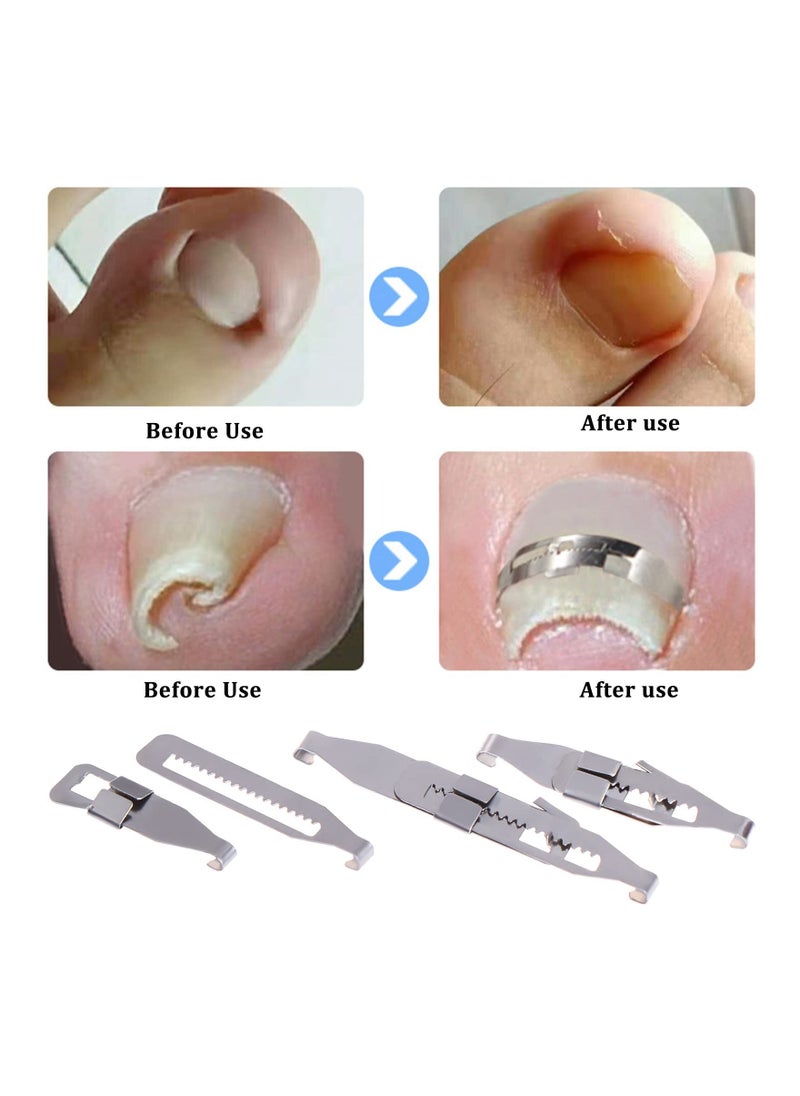 Excefore - Ingrown Straightening Clips Toenail Pedicure Tool Curved Brace Toenails Thick Paronychia Correction Tool, Ingrowing Nail Treatment Kit, 2 Sizes 4 Pcs - Image 1