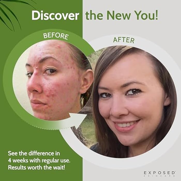 Exposed Skin Care, Clearing Tonic Facial Toner with 1% Salicylic Acid and Witch Hazel – Daily Toner for Teen and Adult Acne, Blackheads and Oily Skin – Natural, Non-Toxic and Cruelty Free - Image 3