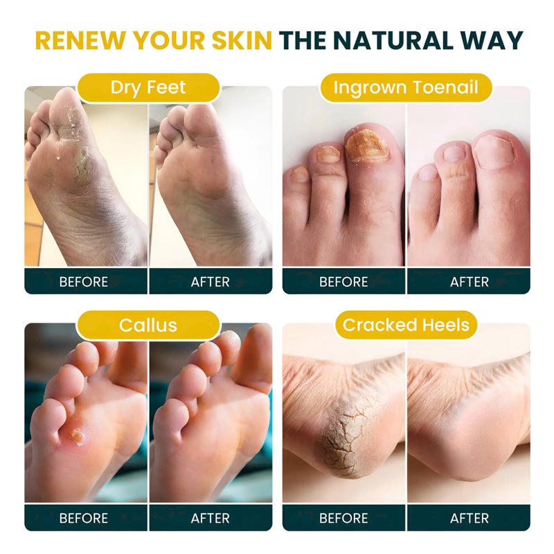 Foot Cure علاج القدم - نقع القدم بالحمضيات مع أملاح إبسوم - لعلاج مسامير القدم، مظهر الأظافر التالفة، سبا باديكير، وتخفيف آلام القدمين المتعبة - 16 أونصة (عبوة من 1) - Image 3
