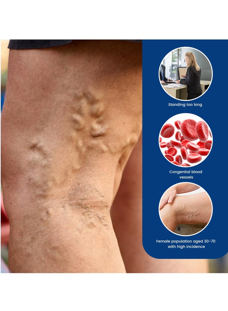 سوميفون مرهم فعال لتخفيف الدوالي الوريدية لعلاج الدوالي لتخفيف التهاب الأوعية الدموية والتهاب الوريد وعلاج آلام العنكبوت - Image 4
