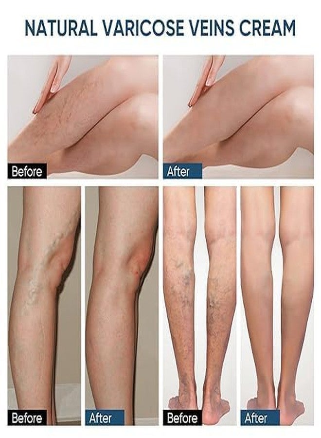 INNPOLE Varicose Veins Remover For Legs Patch Spider Veins Removal for Legs Patch,Improve Blood Circulation, Soothing Leg Fatigue (12) - Image 5