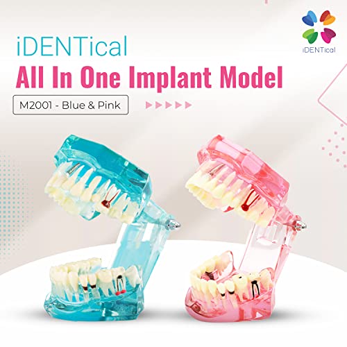 iDENTical All-In-One Implant Model M2001 – Pink | Comprehensive 3D Dental Training Model for Implantology & Restoration | Ideal for Patient Education, Study, and Professional Demonstration - Image 2