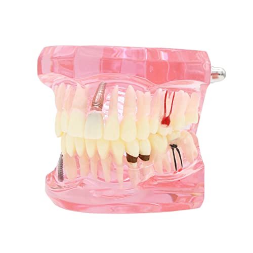 iDENTical All-In-One Implant Model M2001 – Pink | Comprehensive 3D Dental Training Model for Implantology & Restoration | Ideal for Patient Education, Study, and Professional Demonstration - Image 1