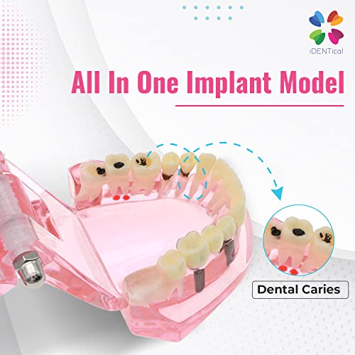 iDENTical All-In-One Implant Model M2001 – Pink | Comprehensive 3D Dental Training Model for Implantology & Restoration | Ideal for Patient Education, Study, and Professional Demonstration - Image 3