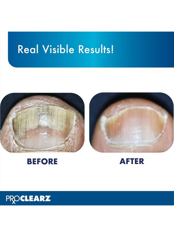 ProClearz علاج الأظافر برايت ناو، يستعيد مظهر الأظافر التالفة والمُصطبغة، تقنية التقشير، إصلاح الأظافر المضيئة والناعمة، 0.5 أونصة - Image 5