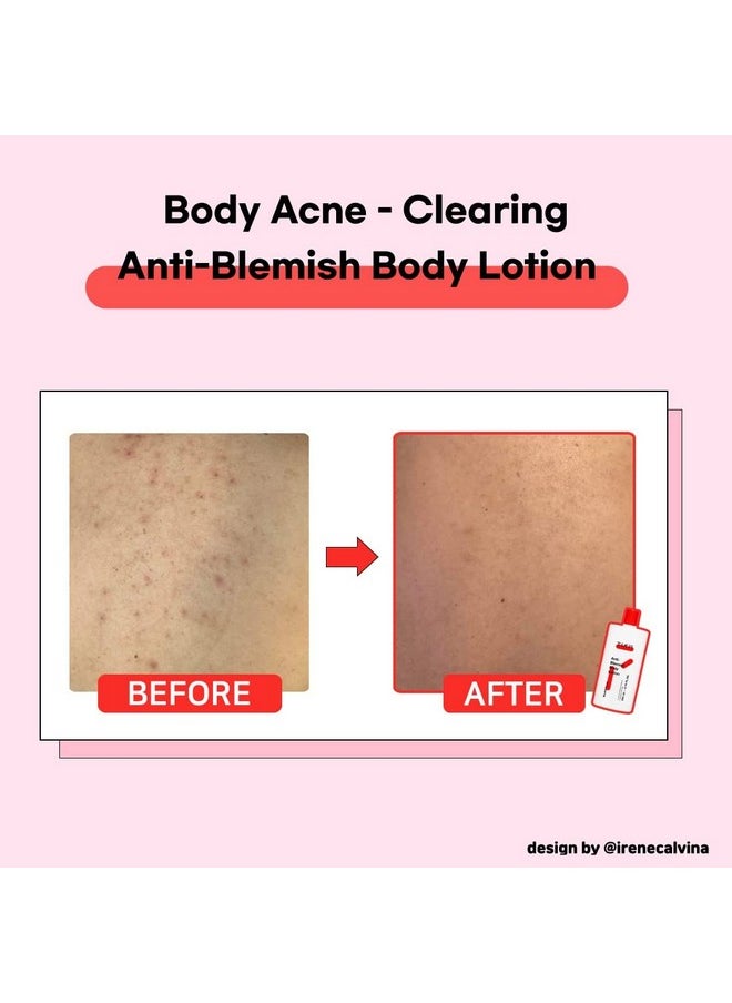 TIAM - Antiblemish Body Lotion Body Acne Treatment Bacne Great For Fighting Breakouts And Acne Scars Removal 6.76 Fl.Oz. - Image 1