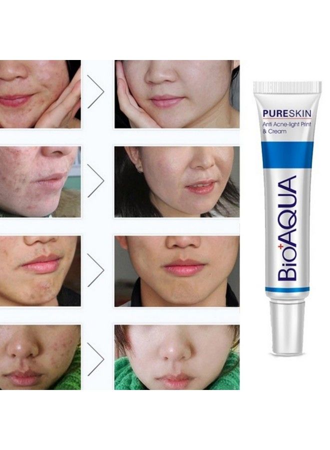 BIOAQUA كريم علاج حب الشباب وإزالة الندبات والبقع على الوجه - Image 5