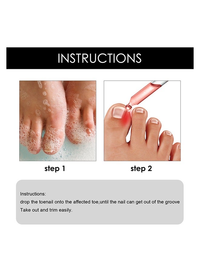 SOUTH MOON Ingrown Toenail Drops Serum 30ml, Ingrown Toenail Relief, Easy Trim Ingrown Toenail Tools, Toenail Fluid With Silicone Gel Toe Caps Essential Oil Diffuser, Ingrown Toenail Reliever and Softener Kit - Image 3