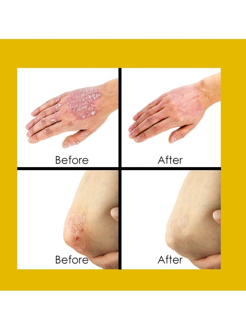 Sumifun Psoriasis Cream, Natural Chinese Herbal Psoriasis Creams for Eczema, Psoriasis Ointment for Dermatitis, Eczema and Itching, Psoriasis Creams - Psoriasis Treatment, Antibacterial Cream, for Body Itching 20g - Image 3