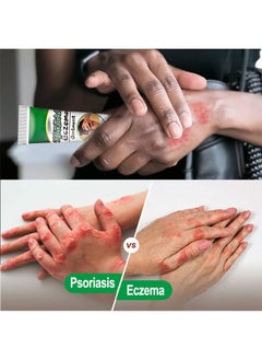 EELHOE Treatment Psoriasis Eczema Cream Antibacterial Antipruritic Dermatitis Herbal Ointment Anti-itch Medical Plaster  - Image 4
