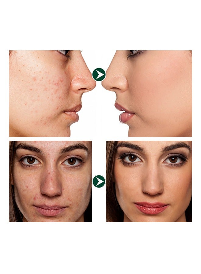 MOIKA Salicylic Acid Acne Removing Essence Gel, Acne Treatment Gel, Acne Spot Treatment for Face & Acne Dots, Natural Cystic Acne Treatment, For All Skin Types, Premium Acne Remover - 20g - Image 3