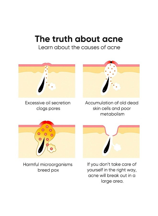 MOIKA Salicylic Acid Acne Removing Essence Gel, Acne Treatment Gel, Acne Spot Treatment for Face & Acne Dots, Natural Cystic Acne Treatment, For All Skin Types, Premium Acne Remover - 20g - Image 4