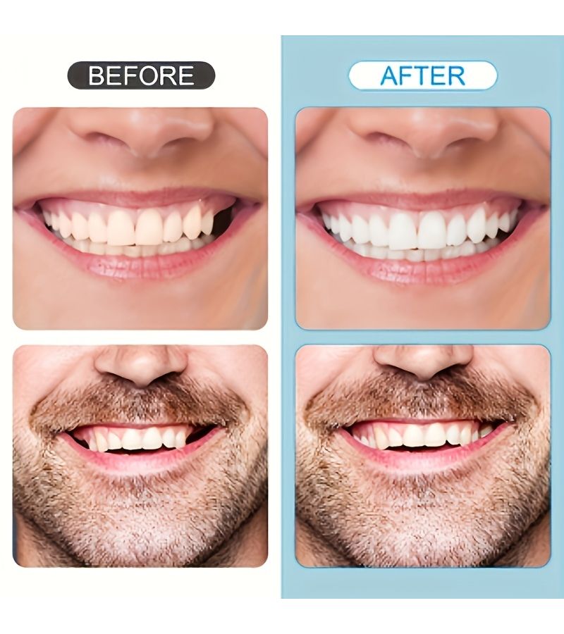 Adjustable Upper And Lower Two Piece Veneer Set Comfortable Flexible Easy To Use Remove Snap On For Men Women Affordable Practical Essential Travel Accessory Gift - Image 3