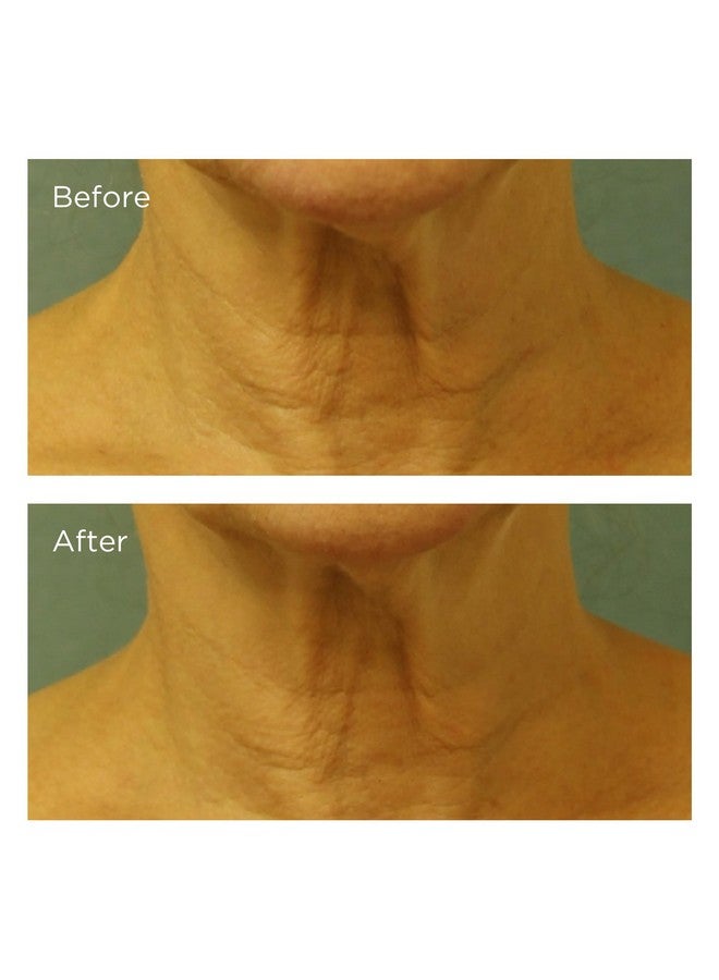 Perricone MD Cold Plasma Plus+ Neck & Chest Broad Spectrum SPF 25, 1 fl. oz. - Image 4