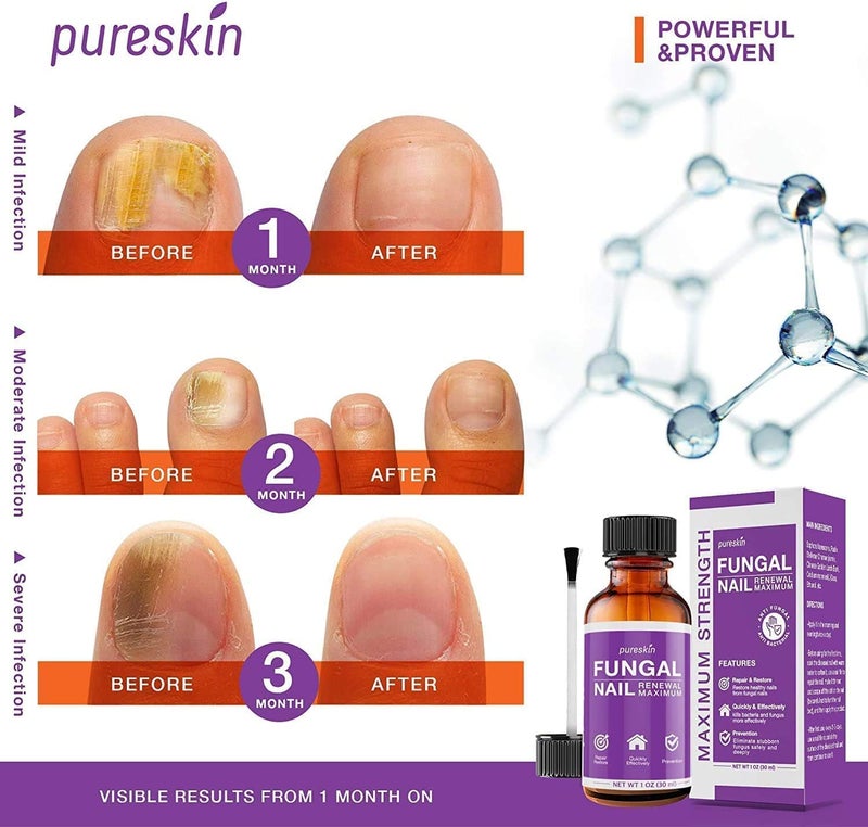 PureSkin PURE SKIN Toenail Fungus Treatment For Toenail & Finernails, Toe Nail Fungus Treatment Extra Strength, Effective Fungal Nail Treatment for Finger & Toenail -1 OZ - Image 3