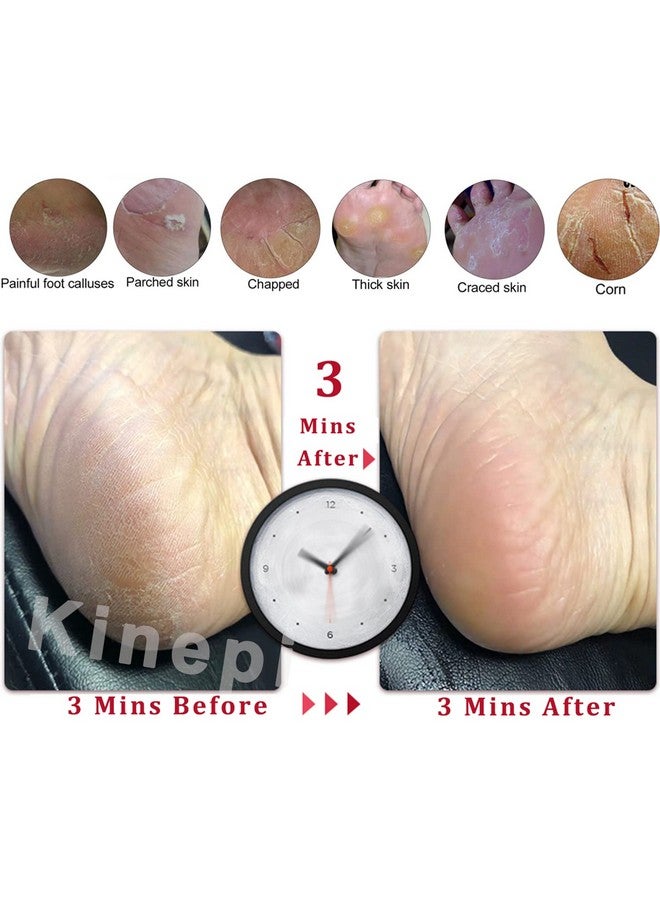 Kinepi Callus Remover Foot Scrubber Colossal Foot File Foot Care And Foot Exfoliator Foot Rasp Pedicure Tools Pumice Stone For Feetremove Corn Hard Skin Dead Skin For Use In Shower Foot Scraper Kit - Image 4