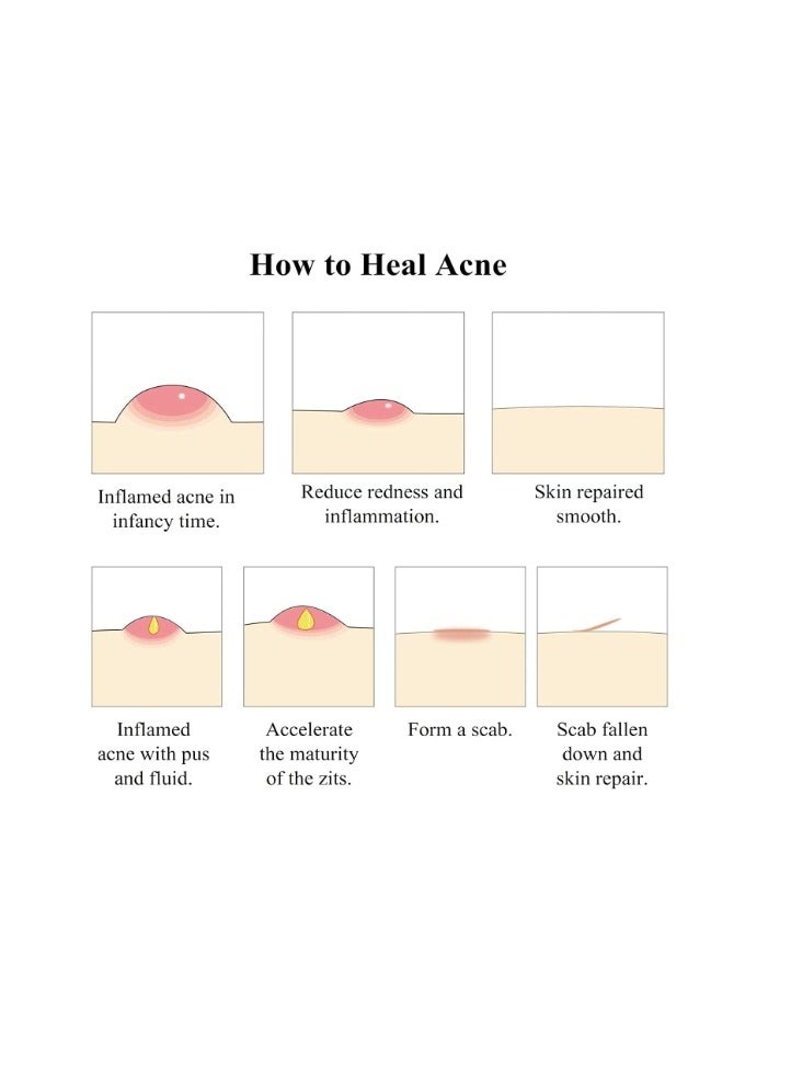 بريلي كريم علاج حب الشباب، كريم حب الشباب بزيت شجرة الشاي لإزالة حب الشباب الشديد والطفح الجلدي وإزالة البثور وإصلاح البشرة 20 جم - Image 5