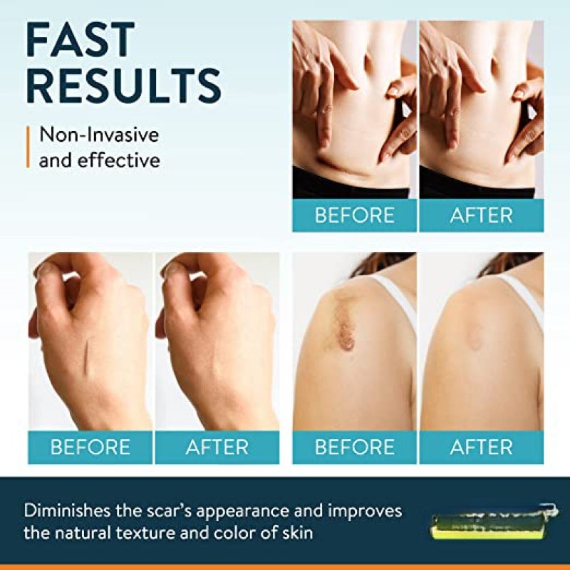 Silicone Scar Sheets 5.7" X 1.57" 4 Pack Advanced Silicone Treatment - Medical-Grade Ingredient Scar Tape - Easy To Apply & Remove Scar Strips for Post-Surgery Keloid C-Section Scar Treatment - Image 5