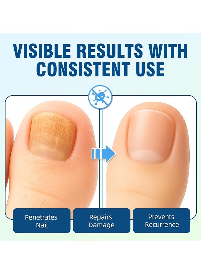ximonth Nail Fungus Care Liquid, Toenail Fungus Treatment Extra Strength, Natural Plant Extract Nail Care For Damaged & Discolored, Toe Nail Fungus Treatments, Fungus Nail Treatment, ToeNail Fungus Treatments For Thick, Broken, Discolored & Damaged Nail, 30ml - Image 2