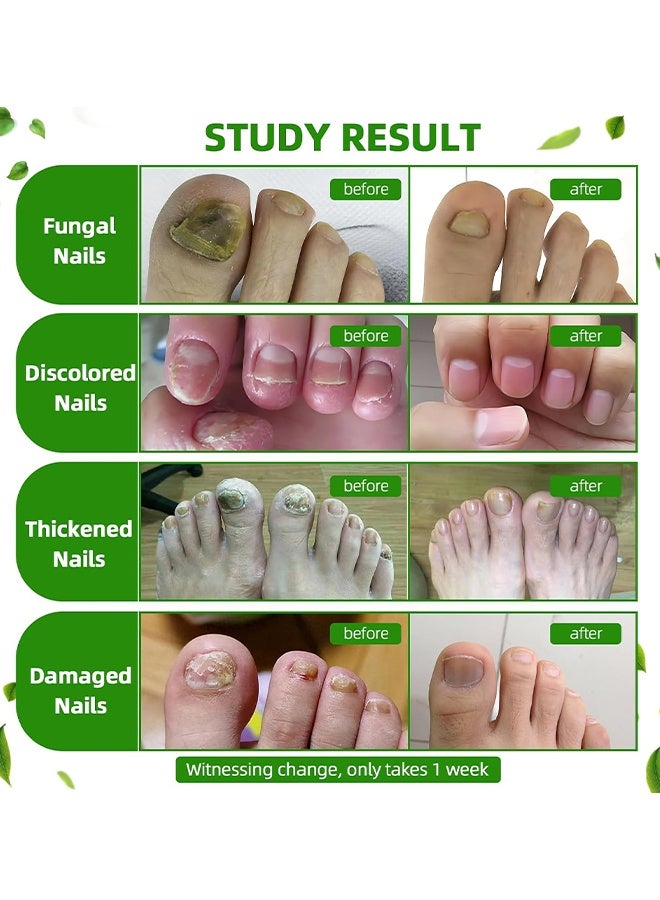 ximonth Nail Fungus Care Liquid, Toenail Fungus Treatment Extra Strength, Natural Plant Extract Nail Care For Damaged & Discolored, Toe Nail Fungus Treatments, Fungus Nail Treatment, ToeNail Fungus Treatments For Thick, Broken, Discolored & Damaged Nail, 30ml - Image 5