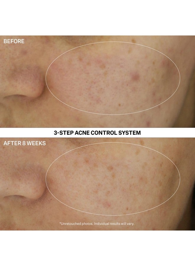 Strivectin Multiaction Clear: 30 Day Trial Kit Acne Control System For Breakouts And Blemishes 3 Piece Set - Image 3