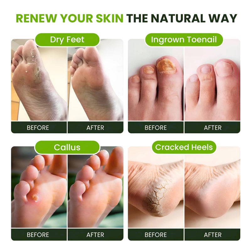 Foot Cure Tea Tree Oil Foot Soak with Epsom Salt - For Toenail Repair, Athletes Foot, Softens Calluses, Soothes Sore & Tired Feet, Nail Discoloration, odor Scent, Spa Pedicure Care - Made in USA 16 oz - Image 5