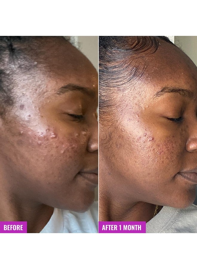 منظف رغوي لحب الشباب من جود موليكلز - غسول رغوي للوجه مضاد لحب الشباب مع حمض الساليسيليك وBHA لعلاج البثور - عناية بالبشرة للوجه مع الصبار وبندق الساحرة - Image 5