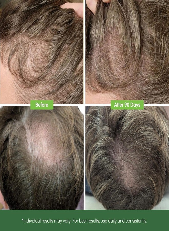 Svvimer Hair Growth Serum Roll On - with Rosemary Batana Oil Biotin Thickening Scalp Serum for Thinning Hair and Loss - for Women and Men 2 PCS 15ml/each - Image 3