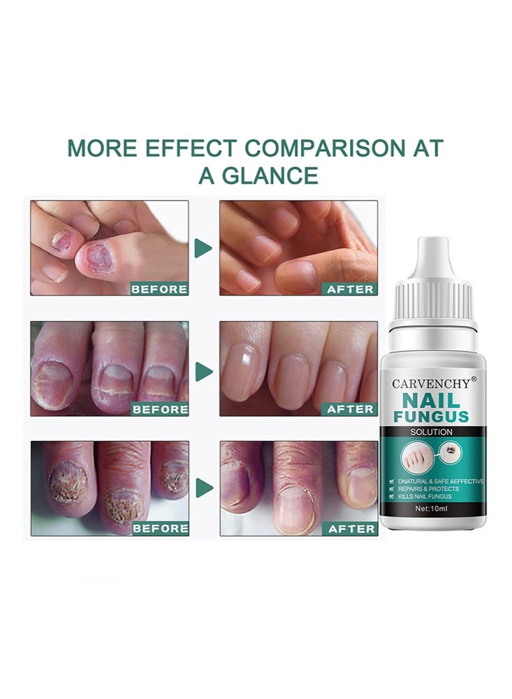 CARVENCHY Nail Fungus Solution-Fixes Discolored Nails, Safe & Effective - Anti Fungus Oil for Ingrown Toenails - Image 3