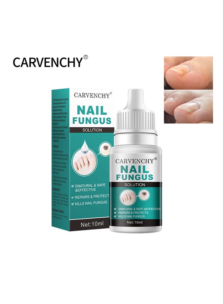 CARVENCHY Nail Fungus Solution-Fixes Discolored Nails, Safe & Effective - Anti Fungus Oil for Ingrown Toenails - Image 1