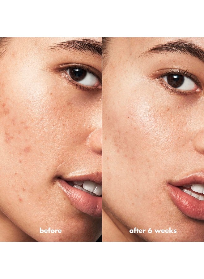 إلف جل إيلف سكين لعلاج حب الشباب، رول أون، لعلاج البقع، مصنوع من حمض الساليسيليك، نباتي وخالٍ من القسوة - Image 4