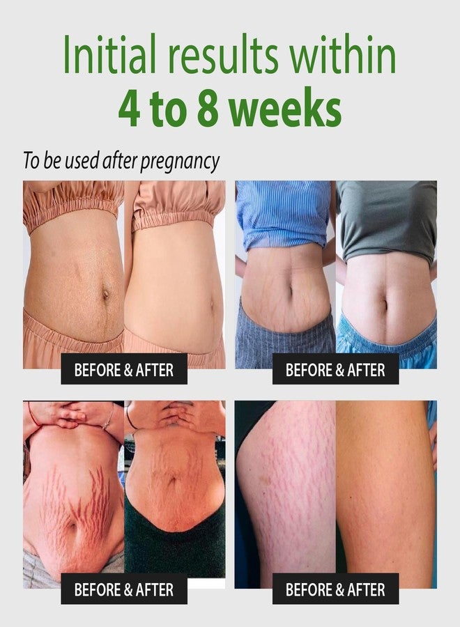 Abera Maternity Stretch Mark Cream for Pregnancy and Weight Fluctuations, Stretch Mark Treatment Pregnancy Must Haves, Deep Stretch Mark Removal - Image 4