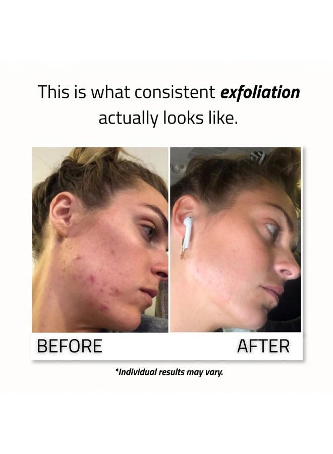 Yeouth Glycolic Acid Face Peel 30% with Retinol and Green Tea, Glycolic Acid Peel Targets the Appearance of Uneven Texture and Dull Skin, 1oz - Image 3