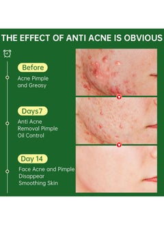 JoyPretty Acne Face Cream Herbal Pimple Scar Removal Shrink Pore Oil Control Moisturizing Facial Cream Acne Treatment Skin Care  - Image 4